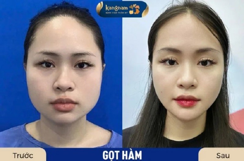 Gọt hàm tại Kangnam đảm bảo an toàn và hiệu quả cao cho khách hàng