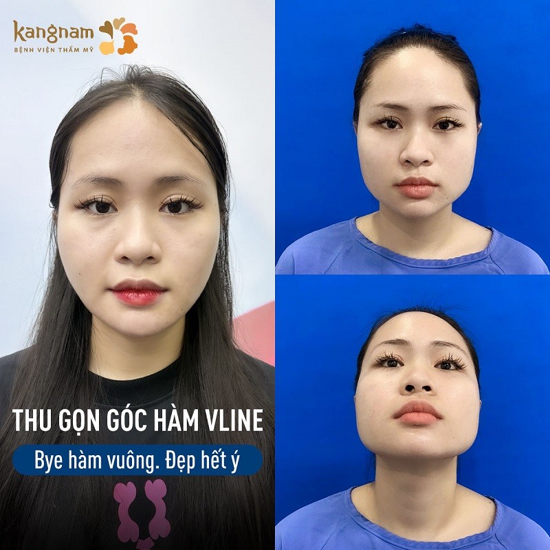 Khách hàng sở hữu khuôn mặt vline, đẹp và cân đôi