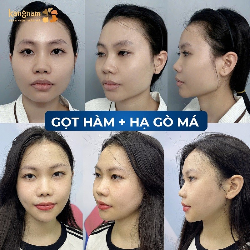 Gọt hàm đúng địa chỉ giúp khách hàng khắc phục được khuyết điểm hàm to, bạnh