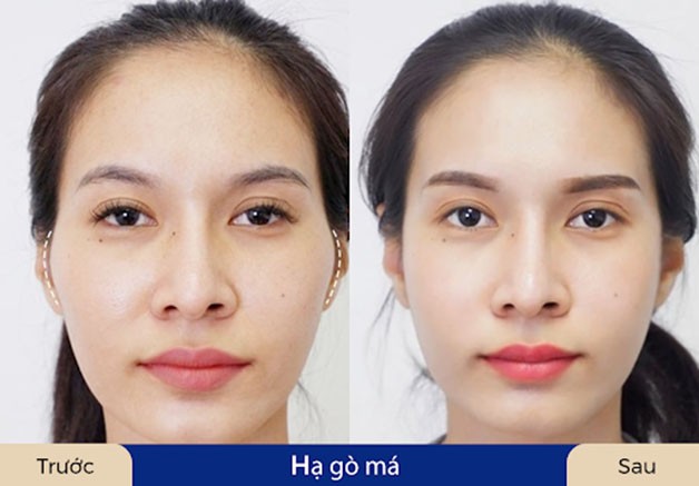 Hạ gò má thường cần từ 1 đến 3 tháng để hồi phục hoàn toàn