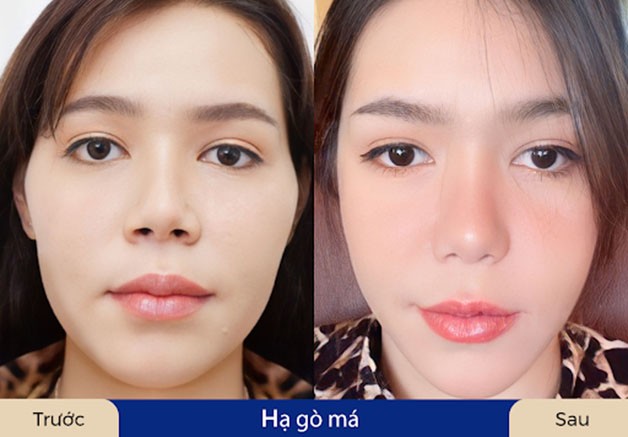 Gương mặt phục hồi hoàn toàn, ăn uống và sinh hoạt trở lại bình thường