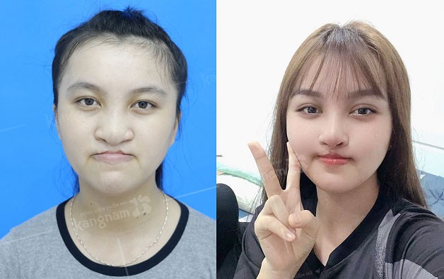Phẫu thuật hở hàm ếch hạn chế sẹo tối đa khi thực hiện đúng kỹ thuật