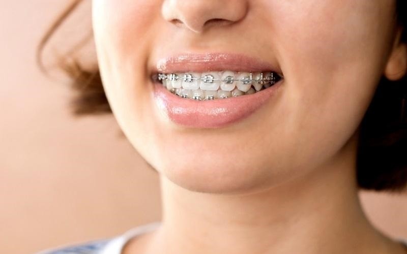 Những trường hợp răng hô có thể niềng răng