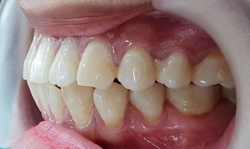 Tình trạng răng chìa ra gây hô nhẹ