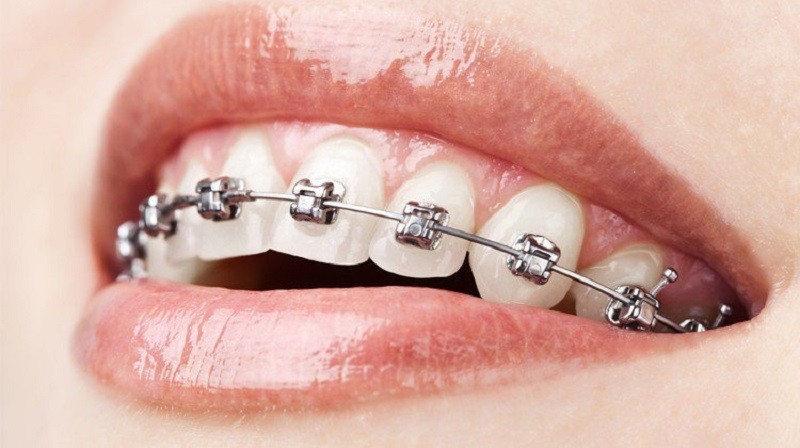 Có thể niềng răng nếu không phải hô do hàm