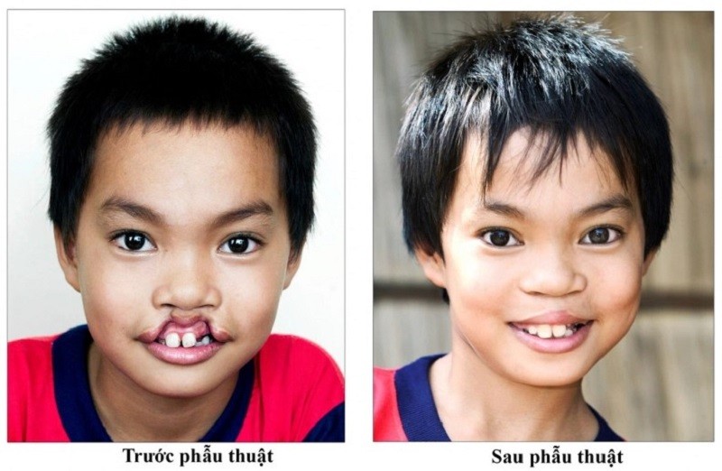 Trẻ được can thiệp phẫu thuật khi đủ tuổi và tùy vào tình trạng hở hàm ếch