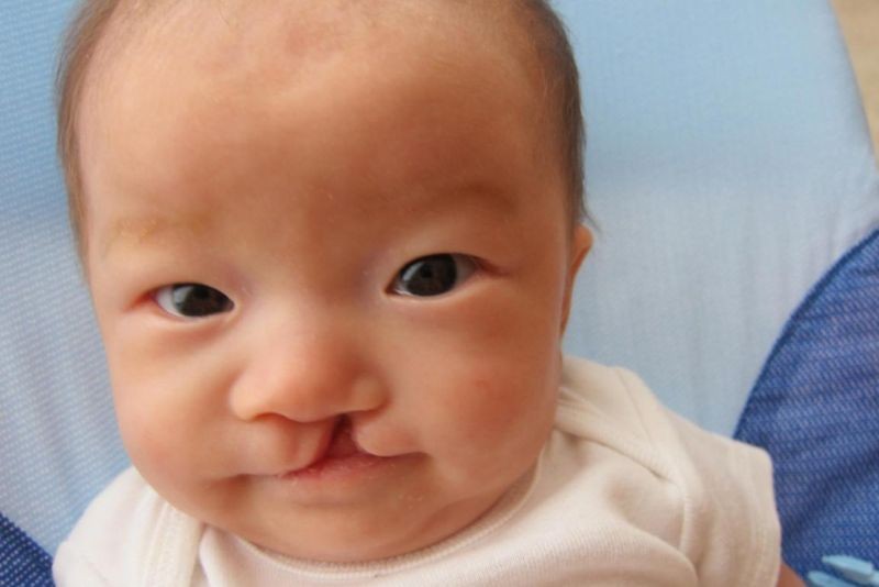 Hở hàm ếch có thể làm thay đổi hình dạng khuôn mặt