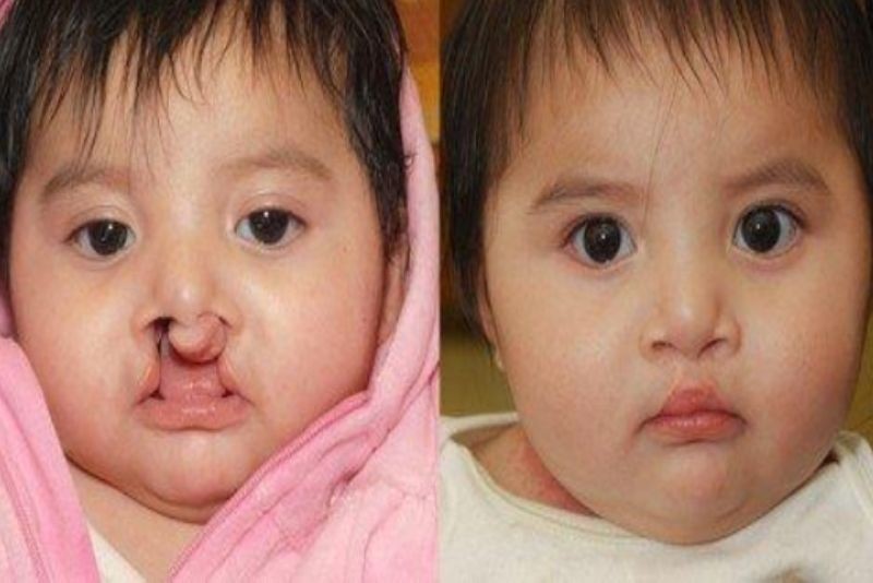 Sứt môi hở hàm ếch có thể chữa được nhờ một loạt ca phẫu thuật sau khi sinh