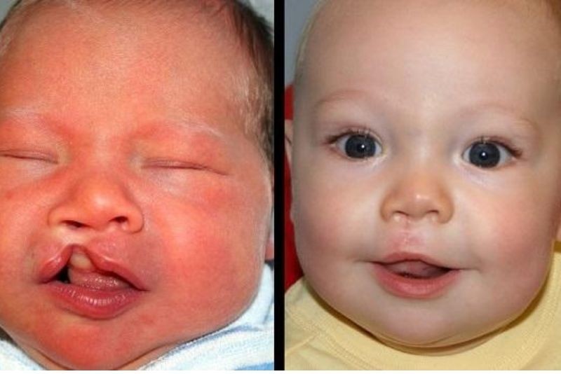 Điều trị sớm giúp trẻ hoàn thiện nhanh