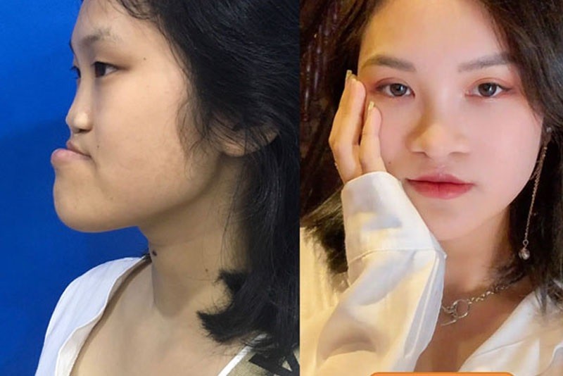 Sau khi lớn vẫn có thể chỉnh hình phẫu thuật hở hàm ếch để đảm bảo tính thẩm mỹ
