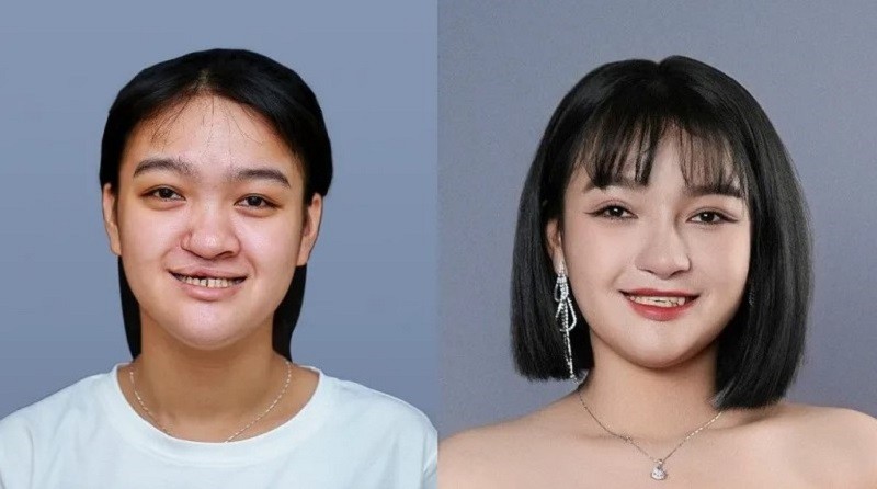 Bùi Như Cảnh (HTLX màu 6) lột xác ngoạn mục sau khi được chỉnh hình hàm mặt