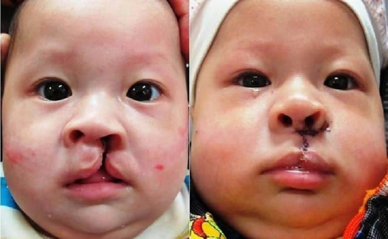 Trẻ có thể phẫu thuật tùy vào từng giai đoạn
