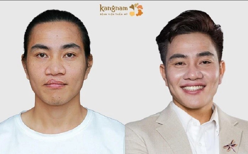 Người lớn được chỉnh hình hở hàm ếch giúp cải thiện tính thẩm mỹ