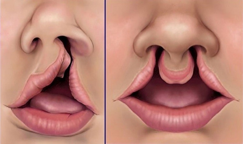 Hở hàm ếch có thể do nguyên nhân di truyền