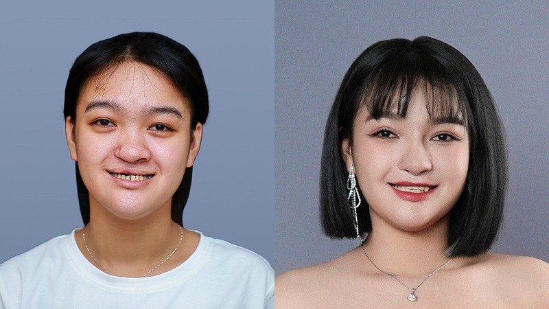 Thí sinh của chương trình Hành trình Lột Xác được phẫu thuật thẩm mỹ miễn phí