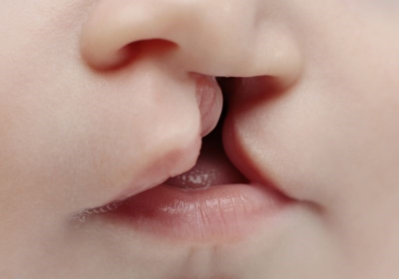 Hở hàm ếch gây khó ăn cho trẻ