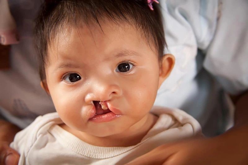 Hở hàm ếch (còn gọi là khe hở vòm miệng) là dị tật bẩm sinh khiến vòm miệng không đóng kín, do quá trình phát triển phôi thai không hoàn thiện