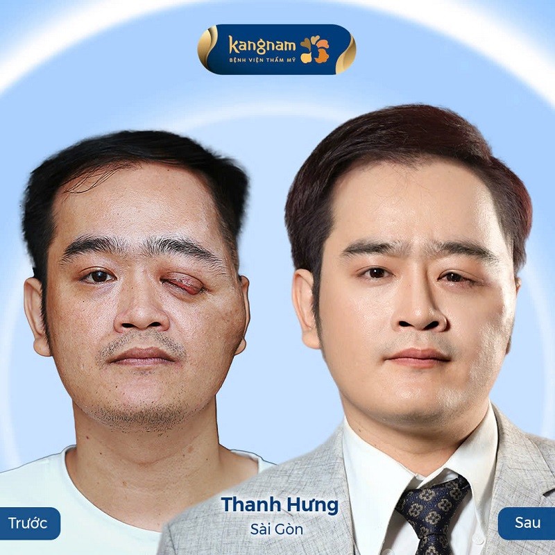 Nguyễn Thanh Hưng trải qua 3 lần phẫu thuật để cải thiện khuyết điểm trên khuôn mặt