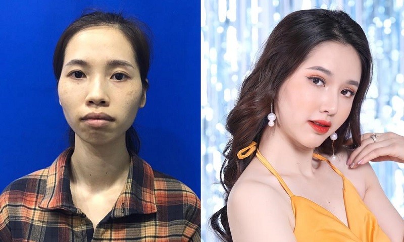 Phan Thị May sở hữu gương mặt xinh đẹp và có cuộc sống tốt hơn sau khi phẫu thuật thẩm mỹ