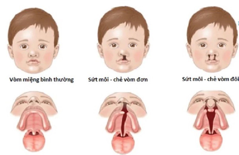 Có thể nhận biết hở hàm ếch khi siêu âm thai hoặc khi trẻ sinh ra