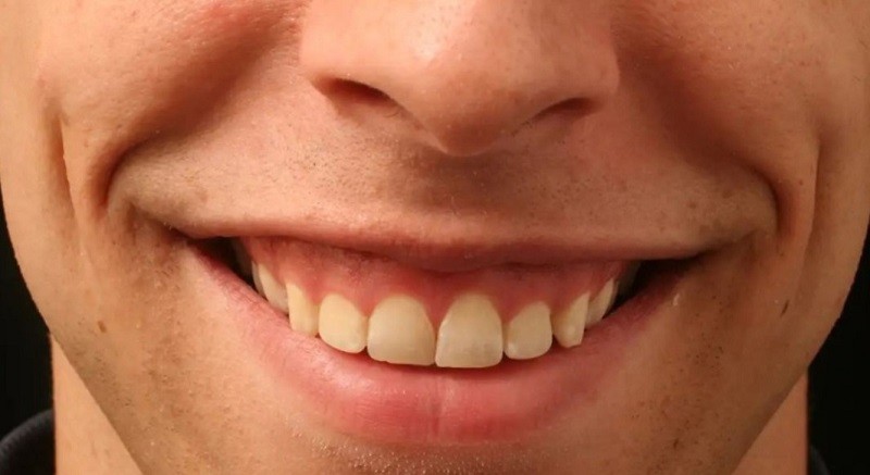 Với góc độ y khoa cười hở lợi ảnh hưởng đến tính thẩm mỹ