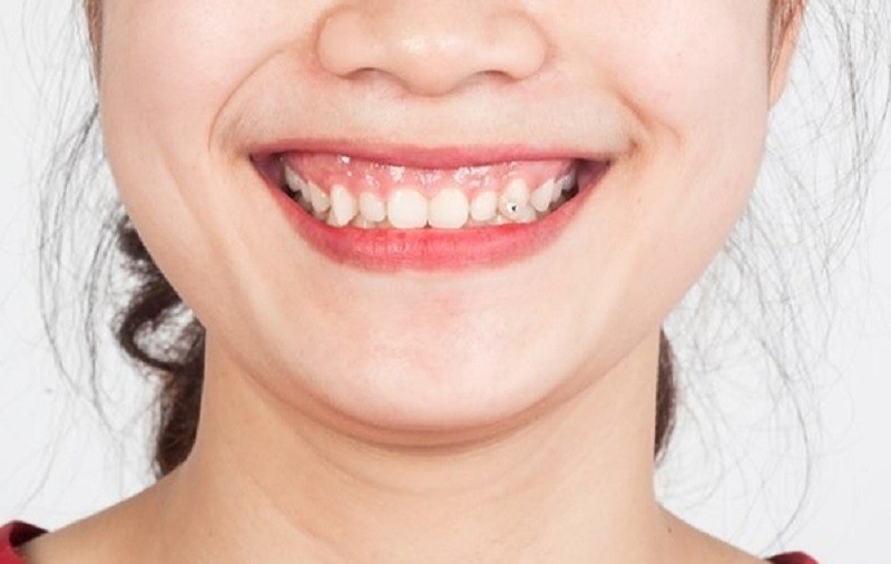 Phụ nữ cười hở lợi được đánh giá có cuộc sống không tốt