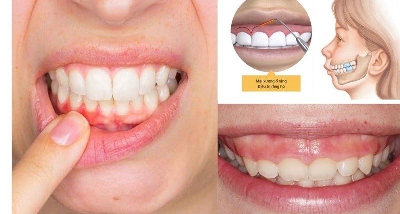 Phẫu thuật cắt lợi với trường hợp lợi phát triển quá mức