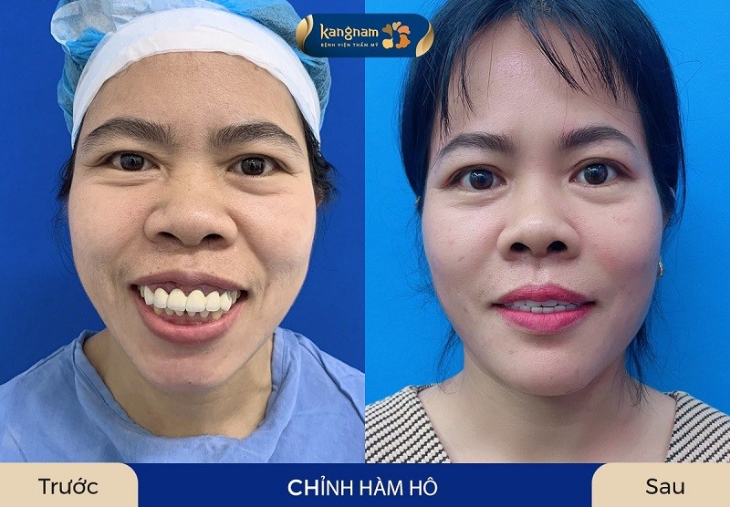 Những người cười hở lợi hoàn toàn có thể điều chỉnh được bằng chỉnh xương hàm