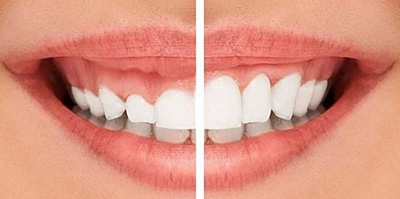 Khắc phục tình trạng cười hở lợi sau phẫu thuật