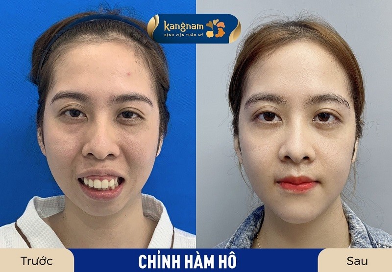 Cười hở lợi do hàm cần thực hiện phẫu thuật