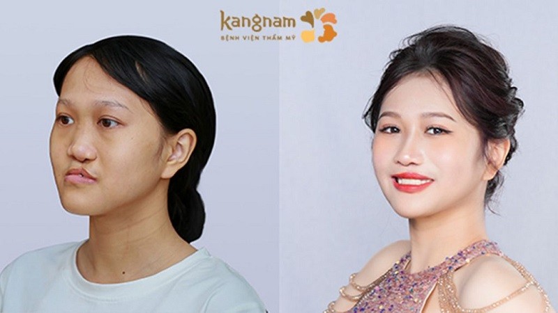 Xuân Mai (thí sinh Hành trình Lột xác mùa 6) sở hữu diện mạo xinh đẹp sau phẫu thuật