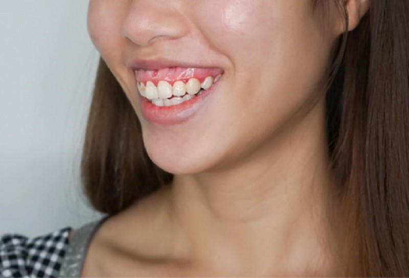 Cười hở lợi là tình trạng khi cười, phần nướu (lợi) ở hàm trên lộ ra quá nhiều từ 2–3mm trở lên