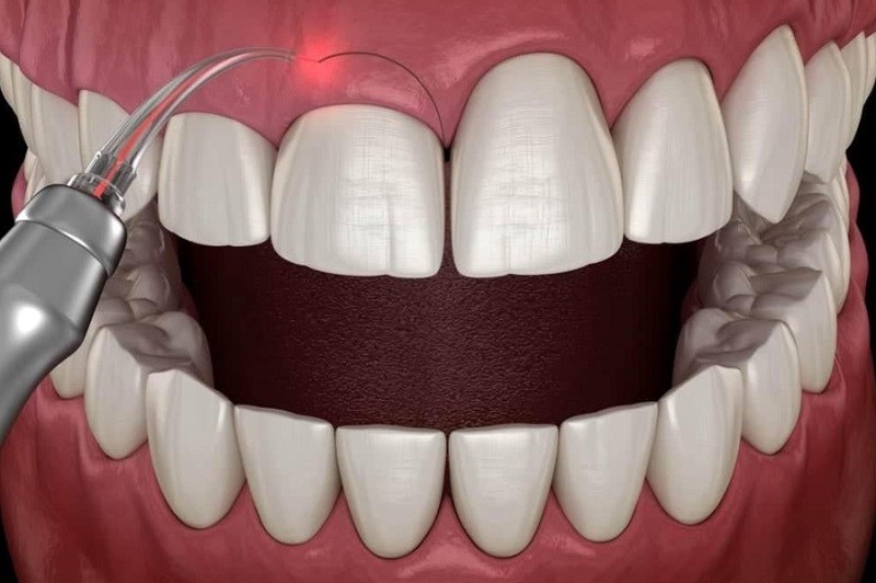Cắt nướu giúp loại bỏ phần lợi thừa