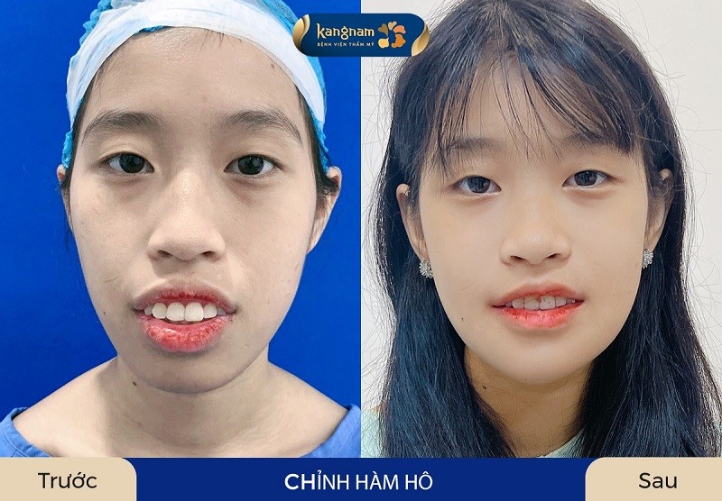 Phẫu thuật chỉnh hàm khắc phục tình trạng <a href=