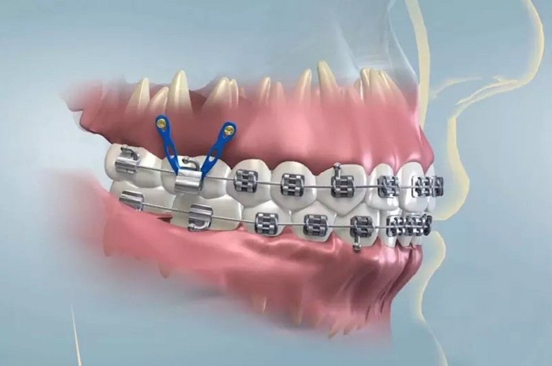 Niềng răng với trường hợp răng hô, cười hở lợi do răng