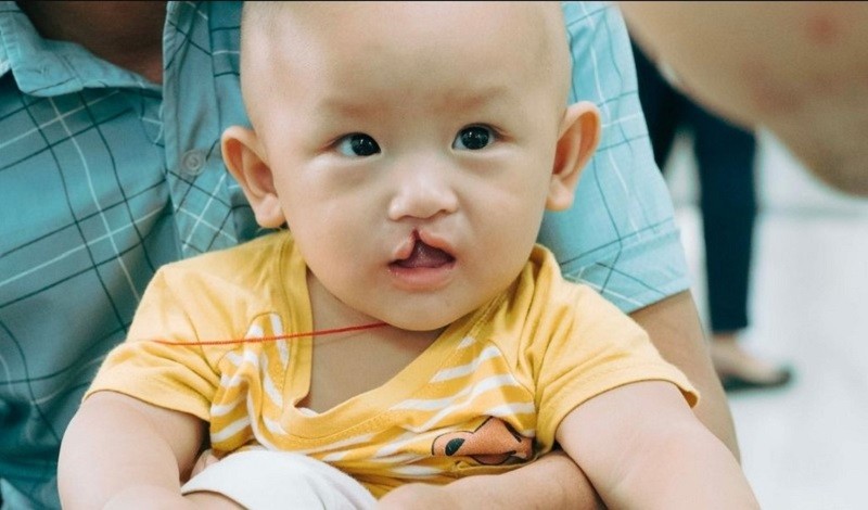 Tình trạng sứt môi hở hàm ếch có thể do di truyền