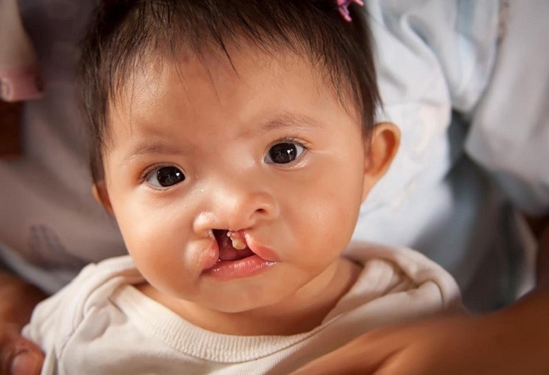 Trẻ nhỏ được phát hiện bị hở hàm ếch thông qua ăn uống