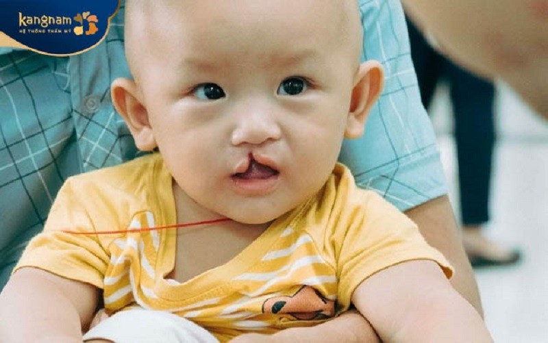 Nếu không điều trị hở hàm ếch có thể gây ảnh hưởng đến cuộc sống và tính thẩm mỹ của trẻ