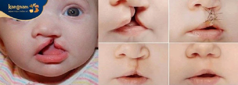 Phẫu thuật giúp trẻ cải thiện chức năng ăn uống, phát âm