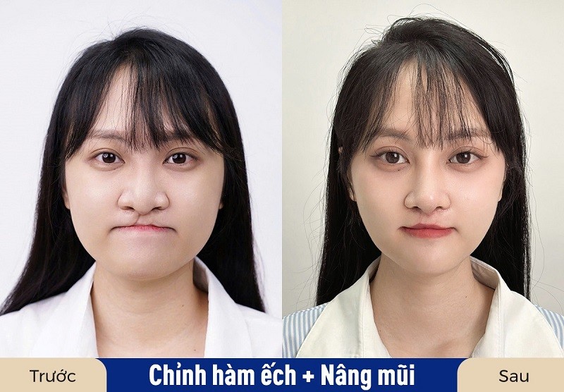 Phẫu thuật chỉnh hình khắc phục tình trạng sứt môi, hàm ếch