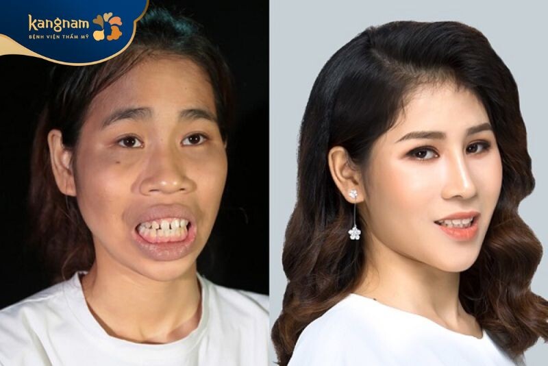 Thí sinh lột xác sau khi chỉnh hàm