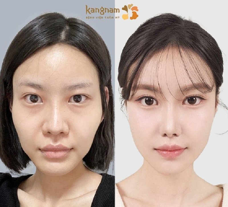 Tiêm hạ gò má giúp gương mặt mềm mại, thanh thoát hơn