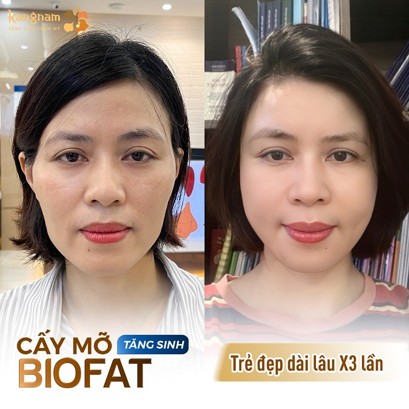 Cấy mỡ tự thân giúp khuôn mặt đầy đặn, thanh thoát hơn