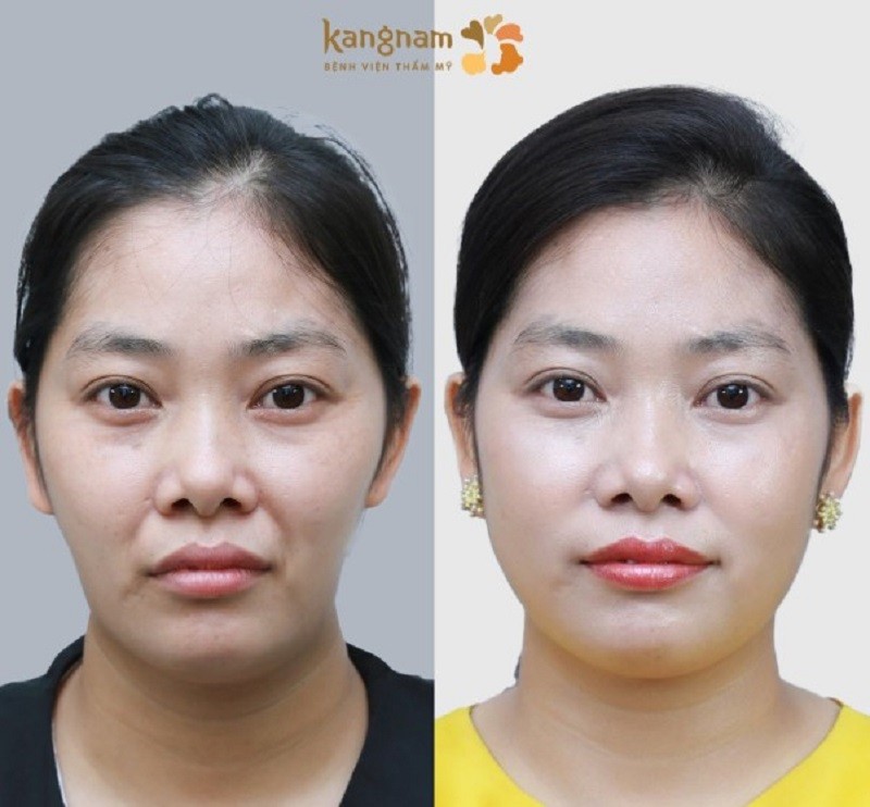 Những người có gò má cao, mặt hóp có thể tiêm hạ gò má