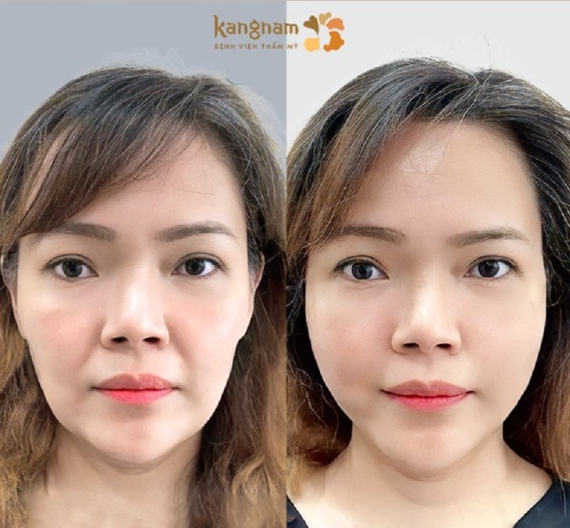 Tiêm filler mang lại hiệu quả nhanh