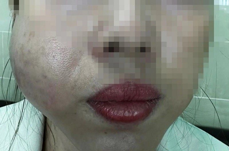 Tiêm hạ gò má bằng sản phẩm kém chất lượng có thể gây vón cục, sưng tấy vùng má lâu dài