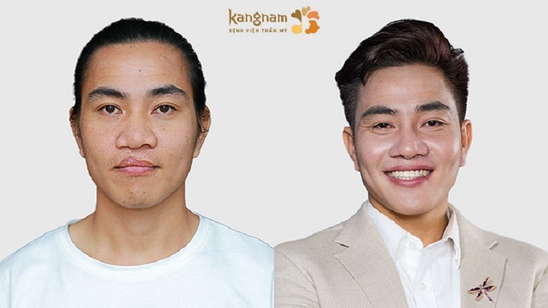 Bệnh viện Thẩm mỹ Kangnam điều trị dị tật sứt môi hở hàm ếch hiệu quả