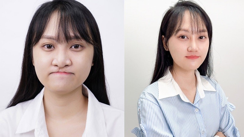 Bệnh viện Thẩm mỹ Kangnam đã thực hiện thành công nhiều ca gặp dị tật hở hàm ếch