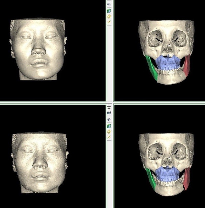 Mô phỏng 3D trước khi phẫu thuật
