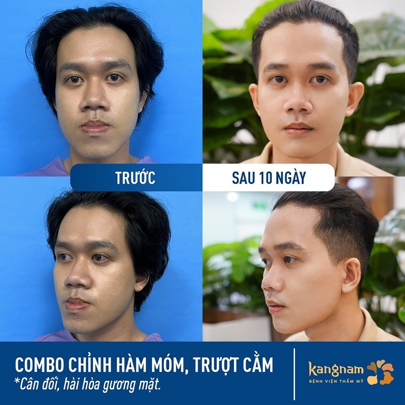 Phương pháp trượt cằm phù hợp với những người có cắm ngắn, lẹm, cằm lệch
